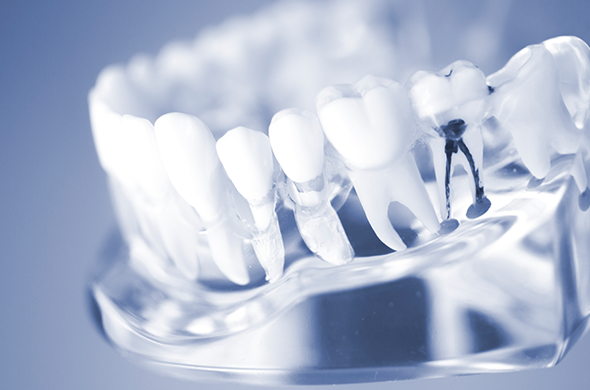 根管治療(歯内療法)